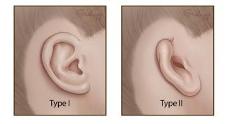 Microtia classification