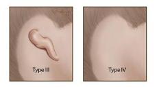 Microtia classification